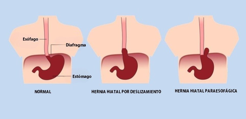 Imagen anatómica de condición normal y tipos de hernia hiatal