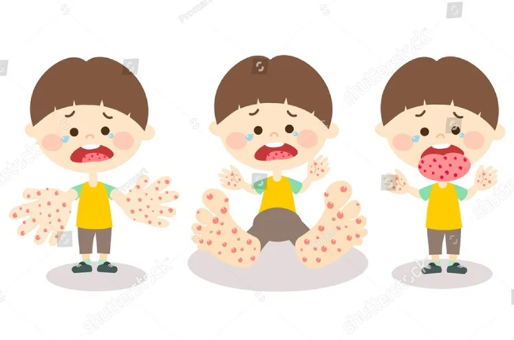 Imagen vectorizada de Niño con Enfermedad manos pies y boca