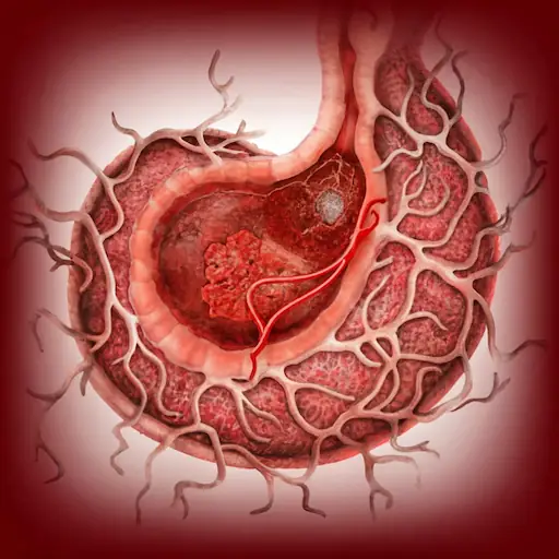 Comprendiendo el Cáncer Gástrico: Síntomas, Prevención y Tratamiento 2 Médico Venezuela Cancer gástrico