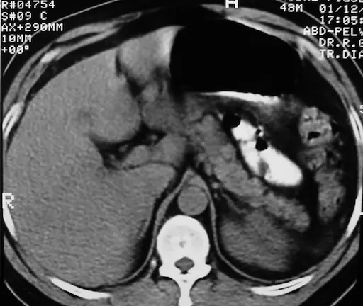 Secretos del Ecosonograma Abdominal: Todo lo que Necesitas Saber 7 Médico Venezuela Tomografía de abdomen